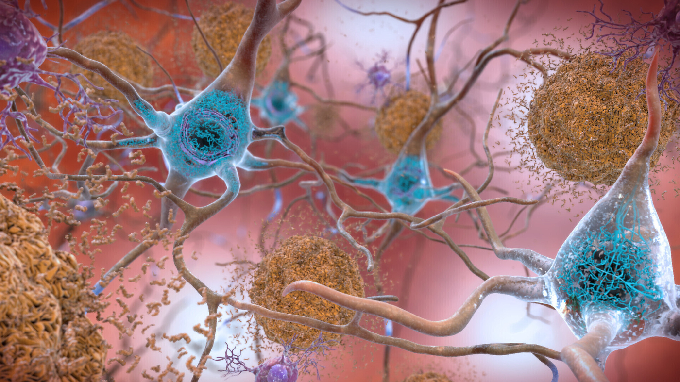 Read more about the article New Alzheimer’s drug, lecanemab, may slow cognitive decline in early alzheimer’s disease